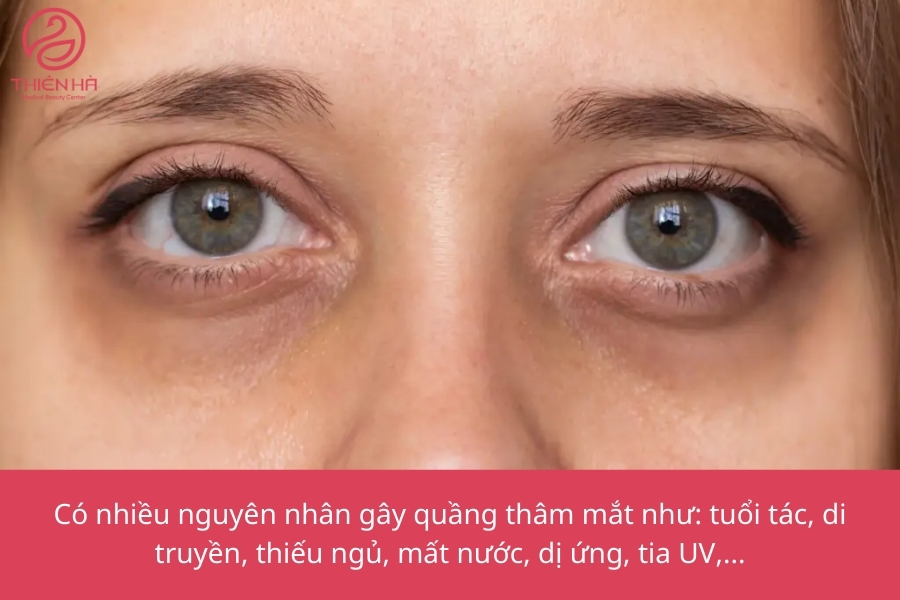 Các nguyên nhân chính ảnh hưởng đến việc xóa thâm quầng mắt giá bao nhiêu.