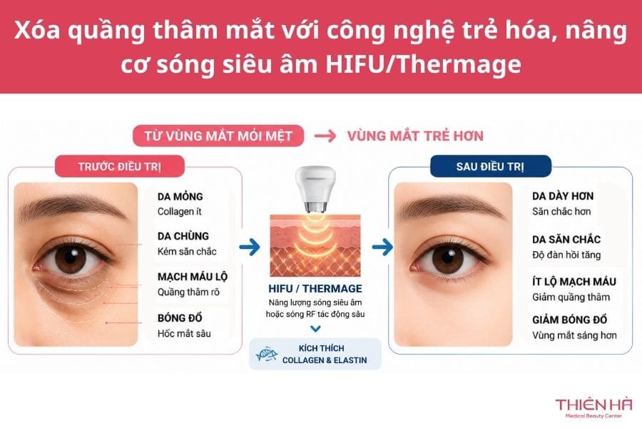 Xóa quầng thâm mắt vĩnh viễn được không? Giải pháp hiệu quả 5 Xóa quầng thâm mắt hiệu quả với công nghệ trẻ hóa, nâng cơ sóng siêu âm HIFU/Thermage