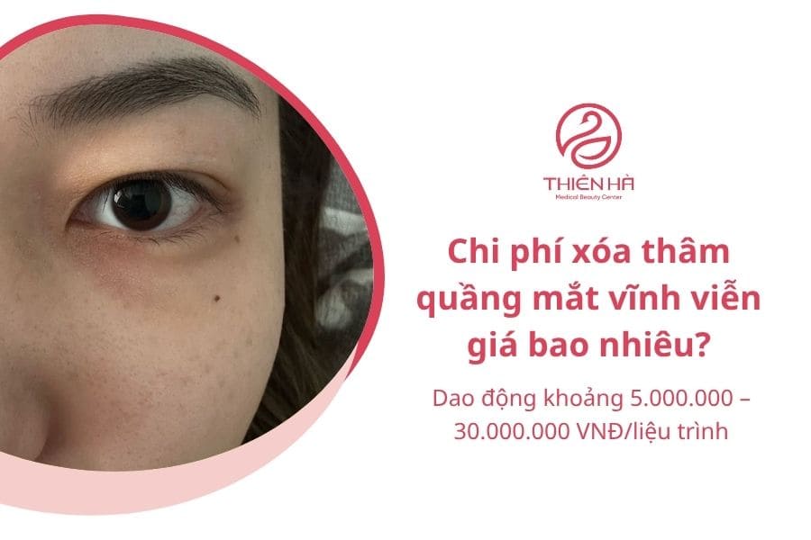Xóa quầng thâm mắt vĩnh viễn được không? Giải pháp hiệu quả 6 Chi phí xóa thâm quầng mắt vĩnh viễn giá bao nhiêu?