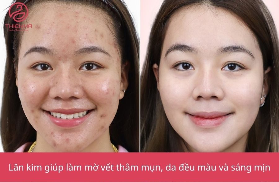 Lợi ích của lăn kim đối với làn da