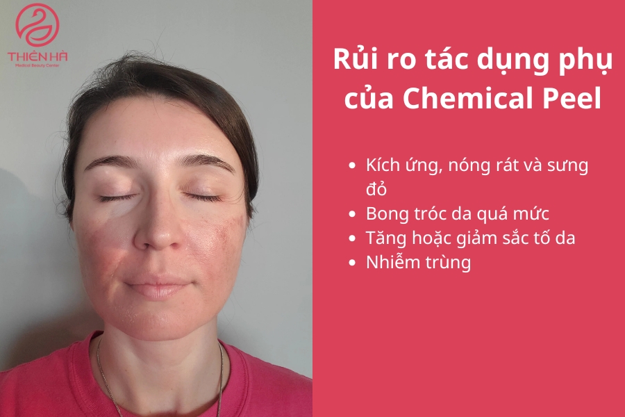  Rủi ro và tác dụng phụ của Chemical Peel