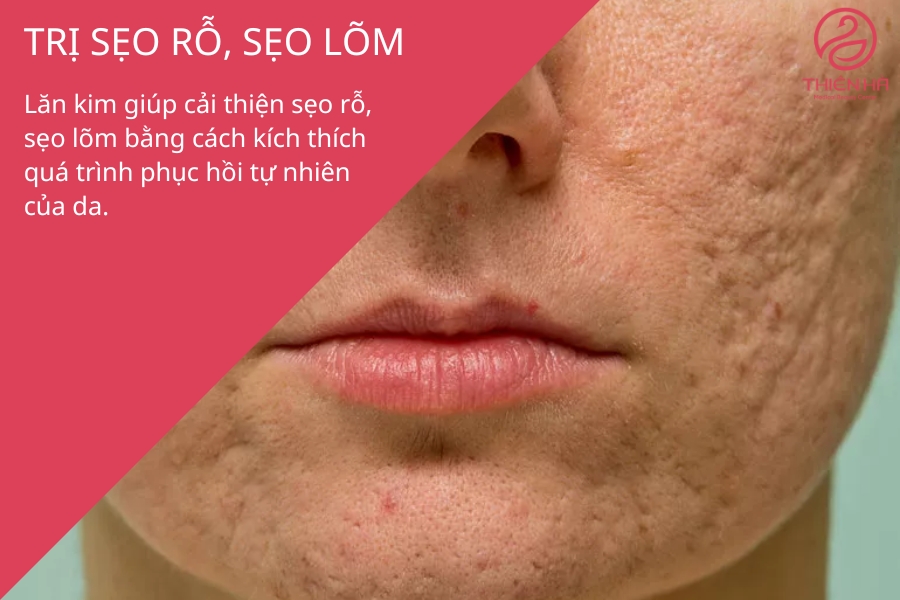 Trị sẹo rỗ, sẹo lõm