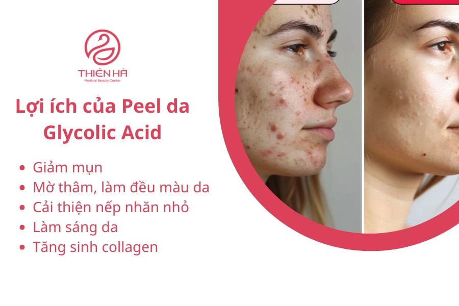  Lợi ích của Peel da Glycolic Acid