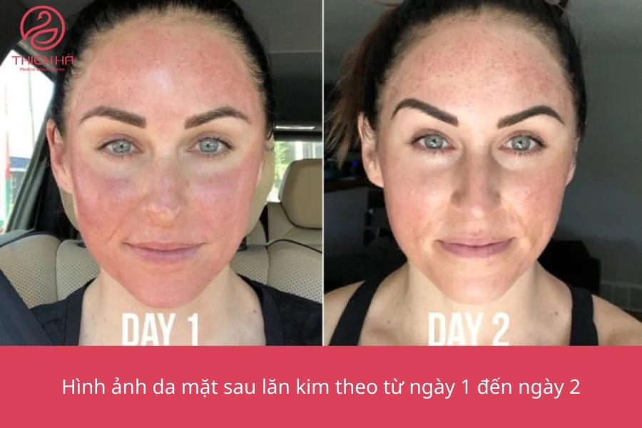 Hình ảnh da mặt sau lăn kim theo từng giai đoạn