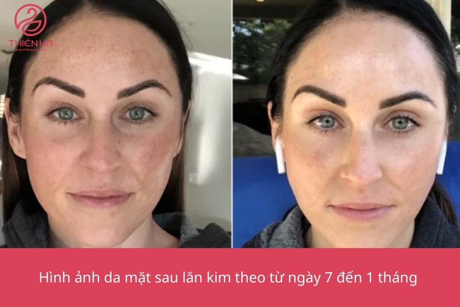 Hình ảnh da mặt sau lăn kim theo từng giai đoạn