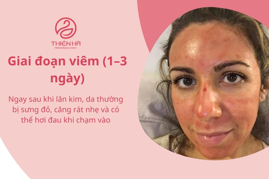 Giai đoạn viêm (1–3 ngày)