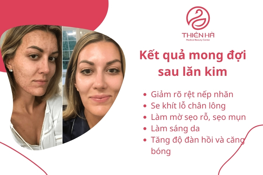 Kết quả mong đợi sau lăn kim
