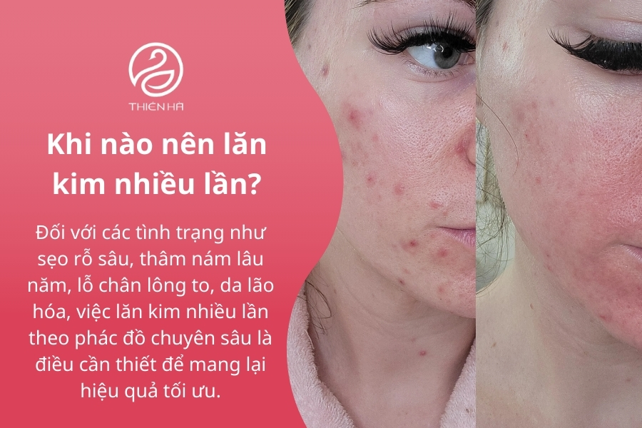  Khi nào nên lăn kim nhiều lần? Lời khuyên từ chuyên gia
