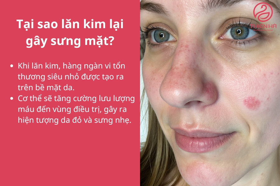 Tại sao lăn kim lại gây sưng mặt