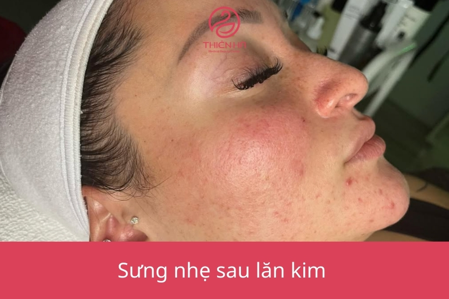 Da hơi ửng đỏ và sưng nhẹ sau khi lăn kim