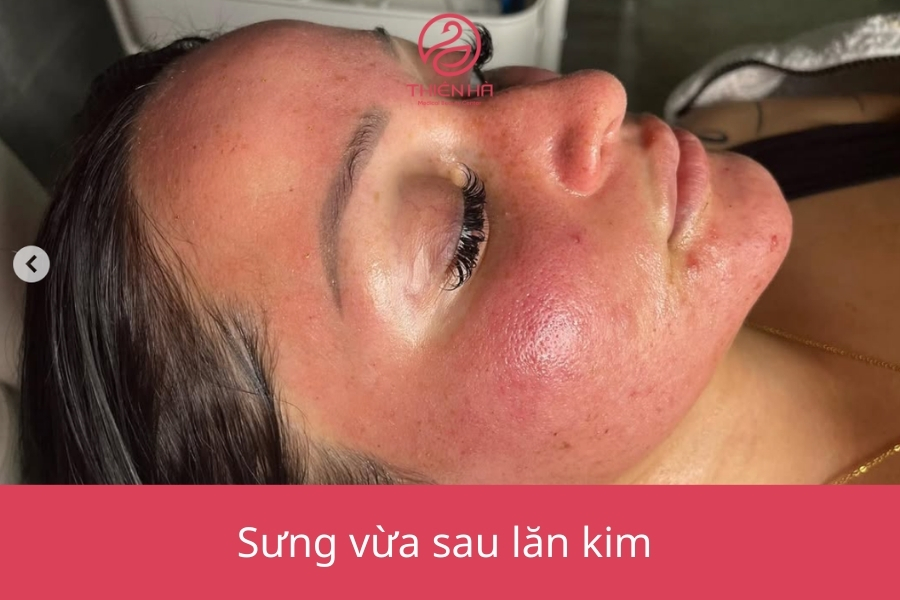 “Da sưng rõ hơn, có thể kèm theo cảm giác căng tức.”