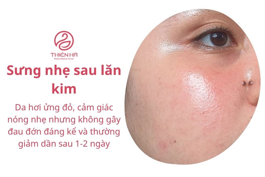 Lăn kim bị sưng mặt: Nguyên nhân, cách xử lý và lời khuyên 3 Da hơi ửng đỏ và sưng nhẹ sau khi lăn kim