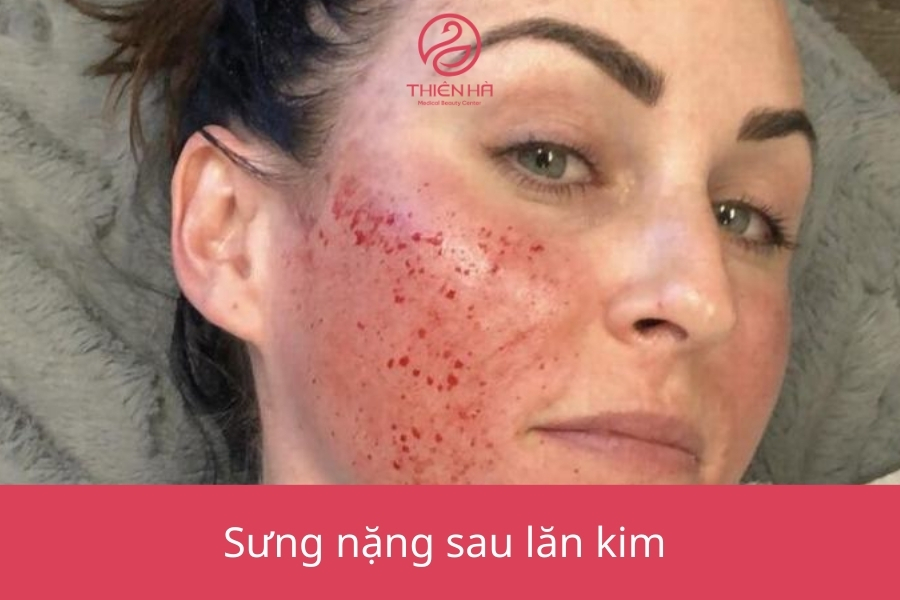 Sưng nặng