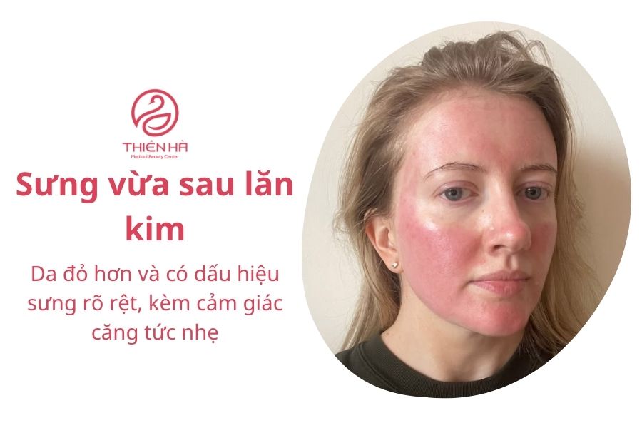 Lăn kim bị sưng mặt: Nguyên nhân, cách xử lý và lời khuyên 4 Da sưng rõ hơn, có thể kèm theo cảm giác căng tức