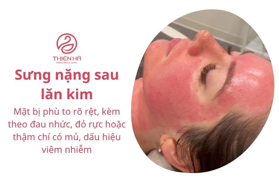 Lăn kim bị sưng mặt: Nguyên nhân, cách xử lý và lời khuyên 5 Sưng nặng sau lăn kim