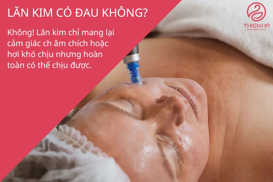  Lăn kim có đau không? Cảm giác thật khi lăn kim