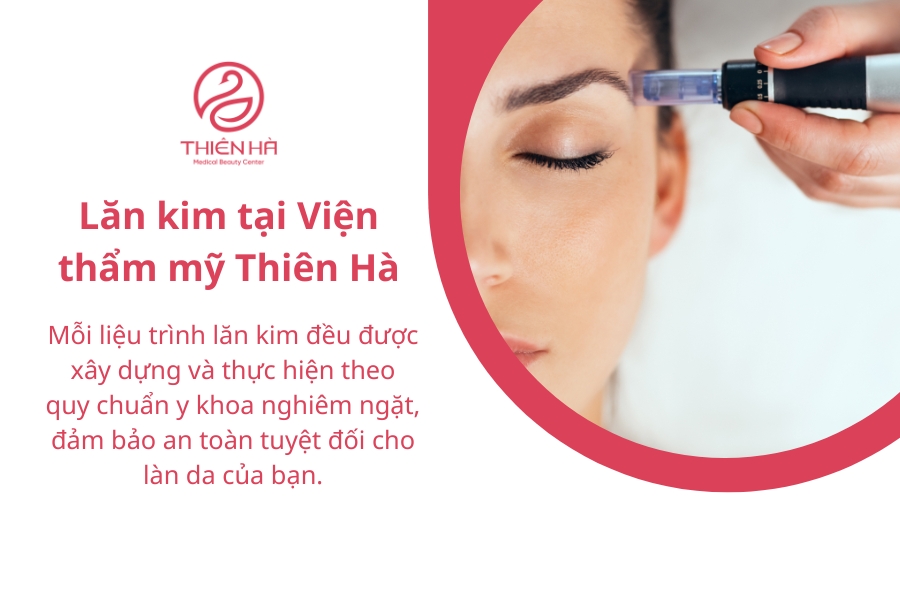 Lăn kim tại Viện thẩm mỹ Thiên Hà: An toàn và hiệu quả