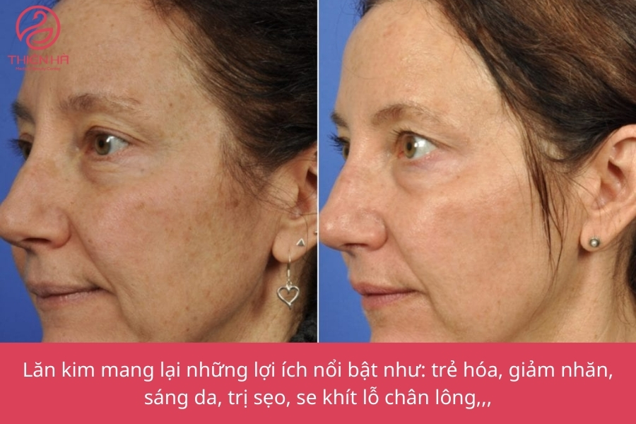 Hình ảnh so sánh làn da trước và sau khi lăn kim cho thấy sự cải thiện rõ rệt về độ mịn màng, độ sáng và sự săn chắc của da.