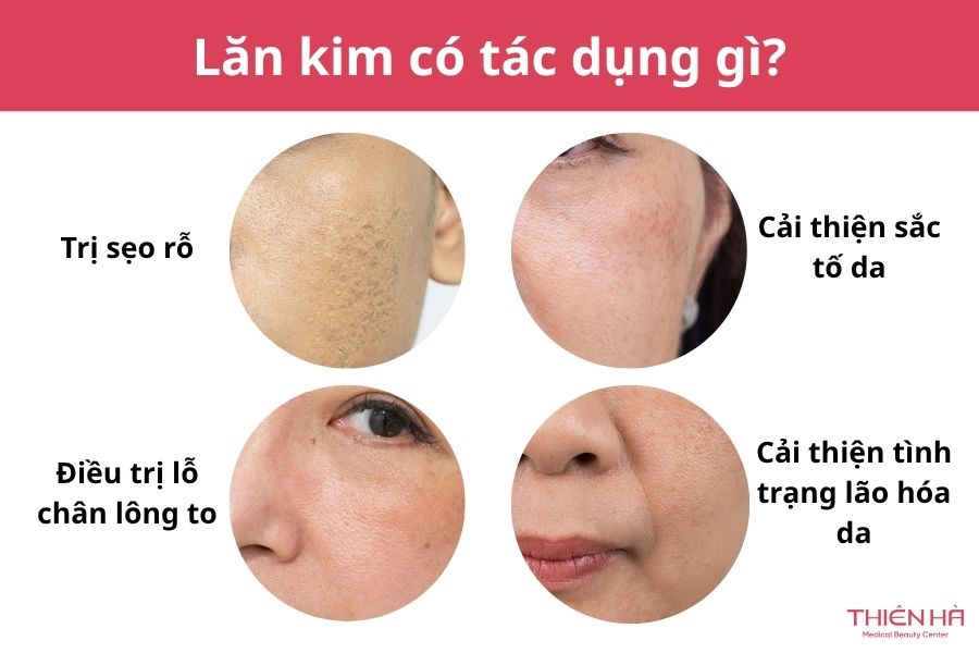 Lăn kim là gì? Tác dụng, quy trình và lưu ý quan trọng 2 Lăn kim có thể giúp làn da cải thiện sẹo rỗ, lỗ chân lông to, sắc tố và tình trạng lão hóa