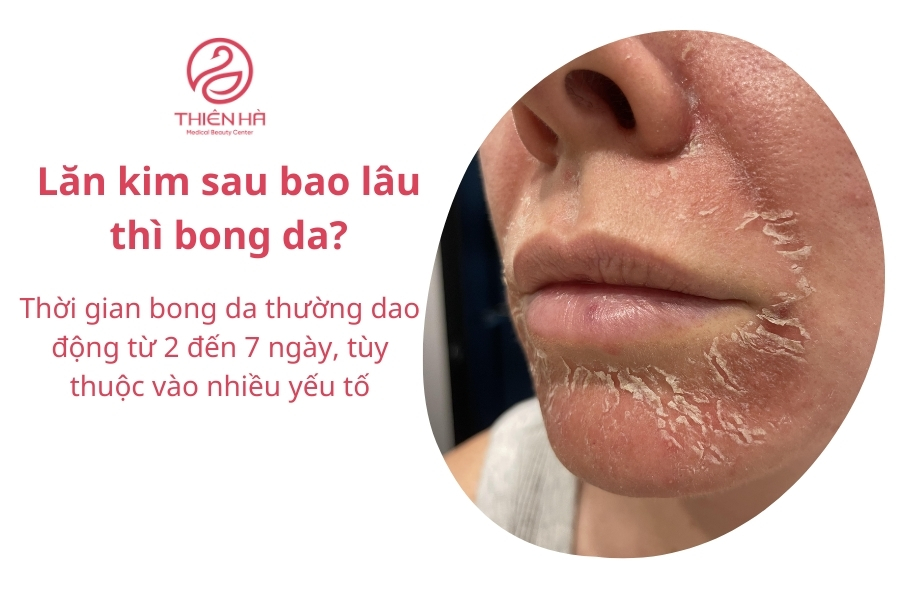  Lăn kim sau bao lâu thì bong da