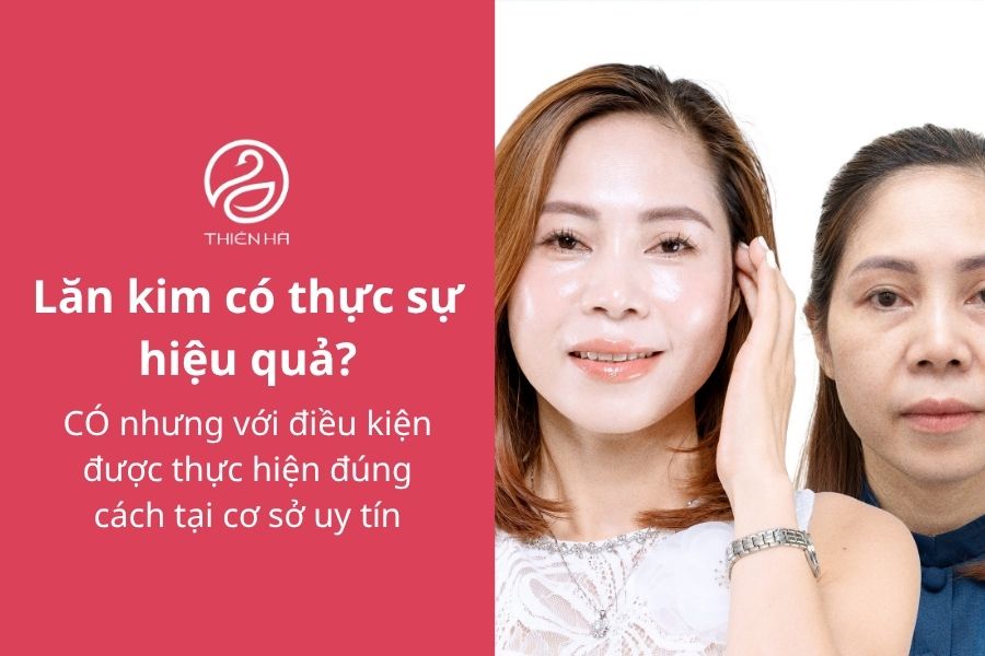 Lăn kim ở đâu hiệu quả và an toàn? Top địa chỉ uy tín 1 Lăn kim có thực sự hiệu quả?