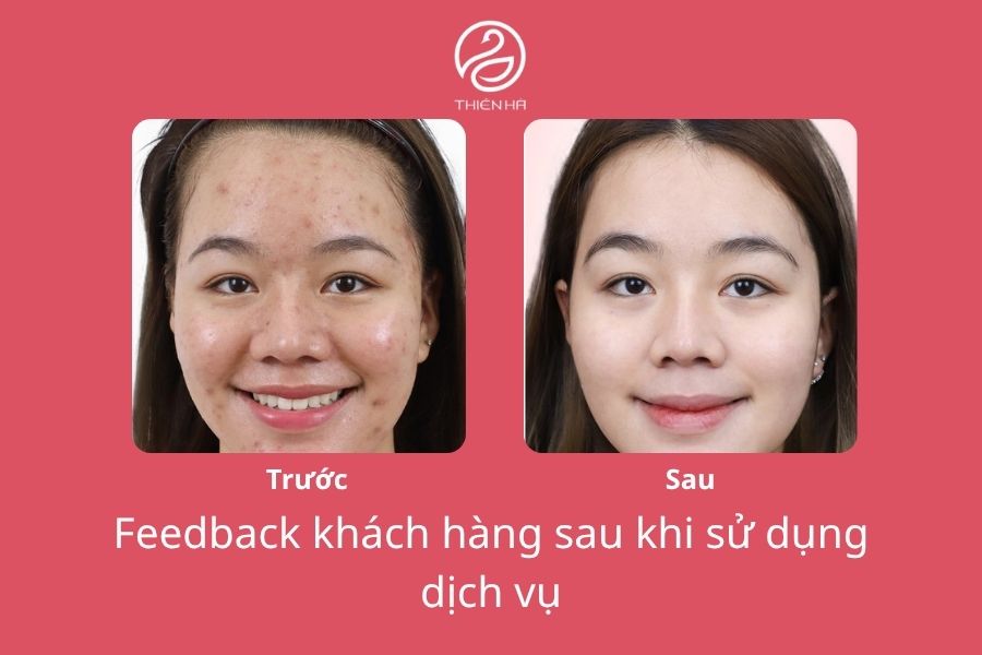 Lăn kim ở đâu hiệu quả và an toàn? Top địa chỉ uy tín 6 Hình ảnh khách hàng trước và sau khi sử dụng dịch vụ lăn kim tại Viện thẩm mỹ Thiên Hà