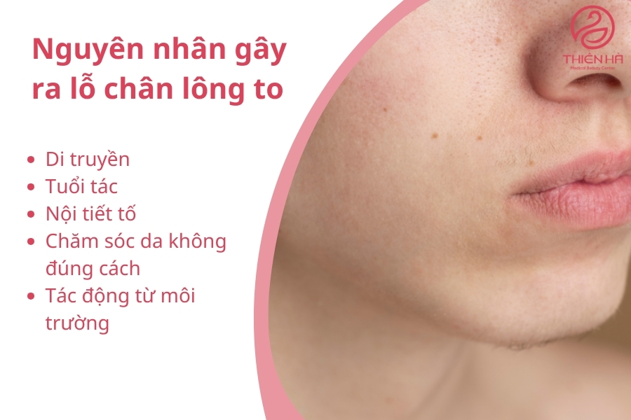 Nguyên nhân gây ra lỗ chân lông to