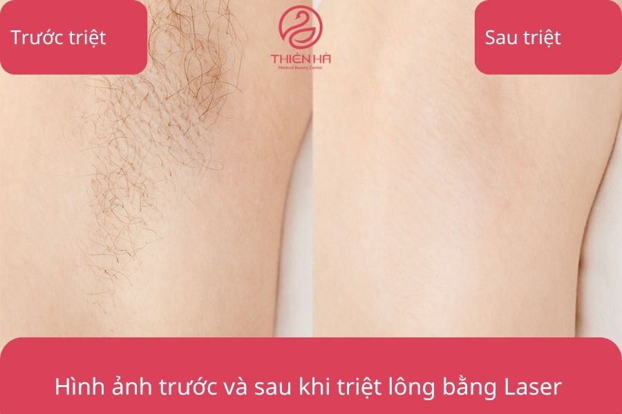 Kết quả trước và sau khi triệt lông