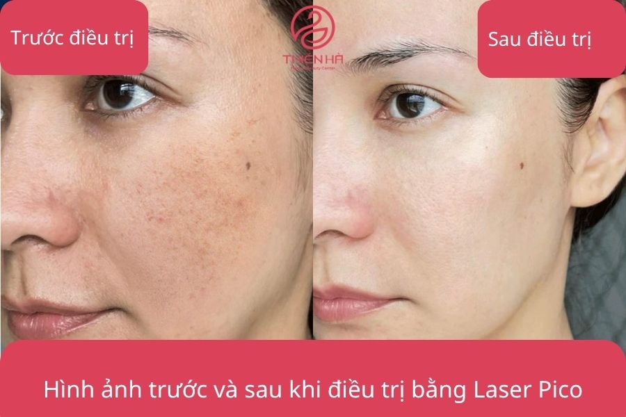Kết quả điều trị ấn tượng với Laser Pico