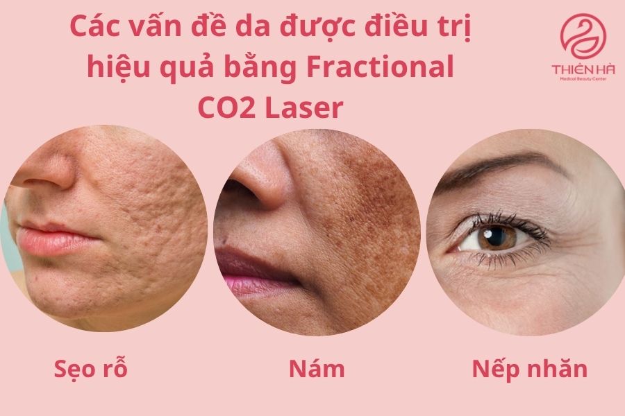 Với khả năng tác động chọn lọc vào từng điểm nhỏ trên bề mặt da, máy vừa đảm bảo hiệu quả cao vừa rút ngắn thời gian phục hồi cho khách hàng.
