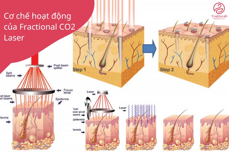 Quá trình thúc đẩy sự tăng sinh collagen và elastin