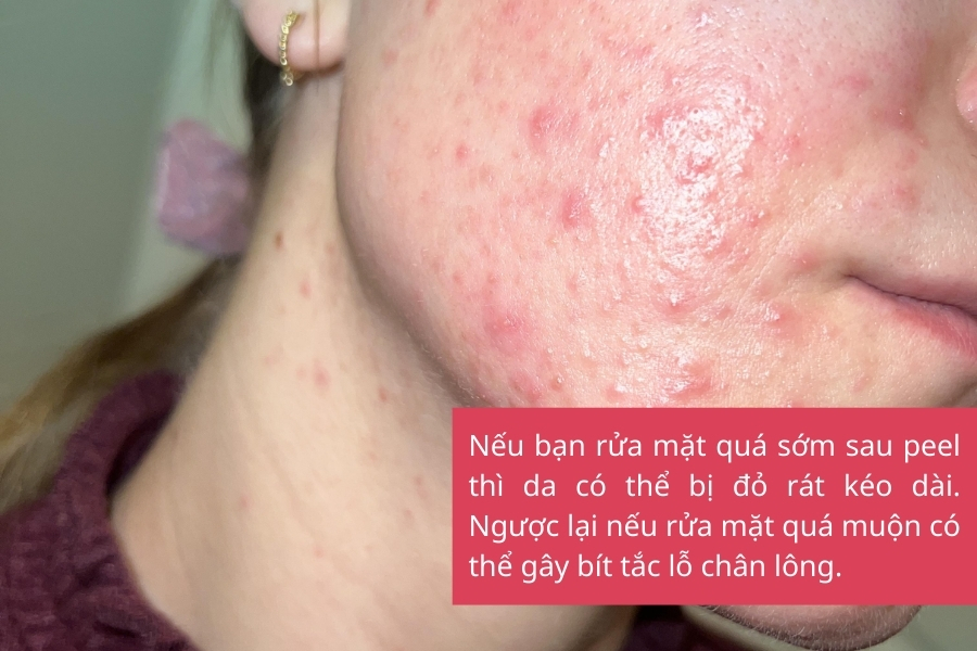 Dấu hiệu cho thấy bạn đã rửa mặt quá sớm hoặc quá muộn
