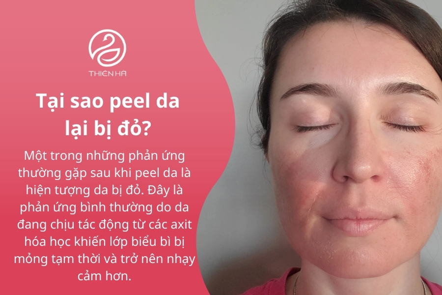 Tại sao peel da lại bị đỏ