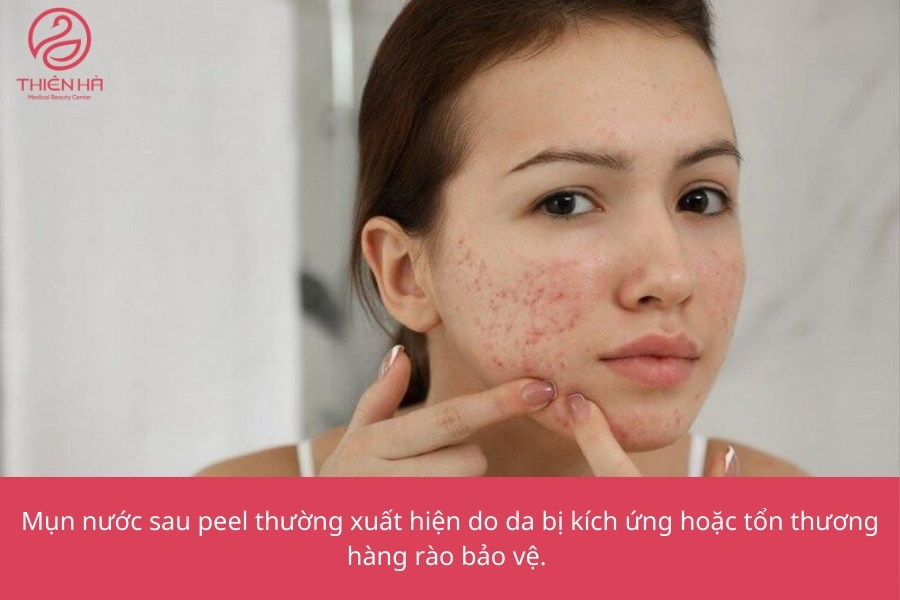  Peel da bị nổi mụn nước là gì