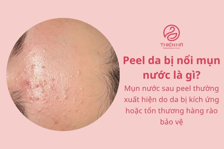 Peel da bị nổi mụn nước là gì