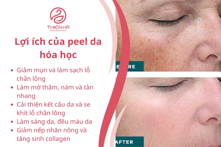 Lợi ích của peel da hóa học