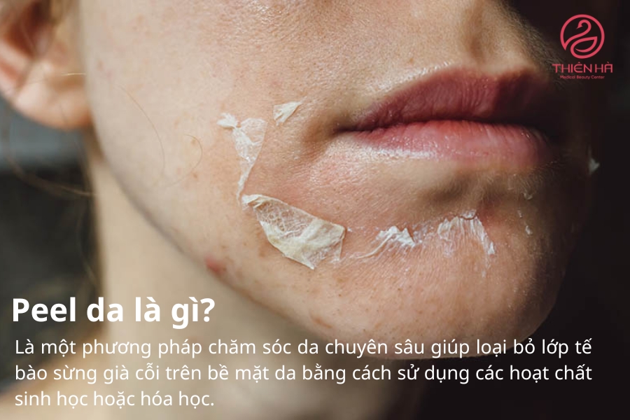 Peel da là gì