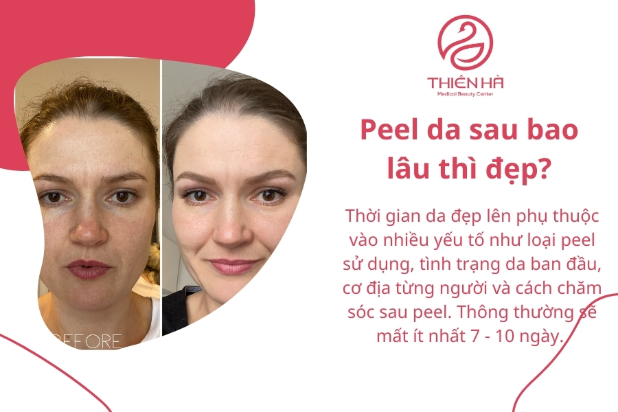 Peel da sau bao lâu thì đẹp?