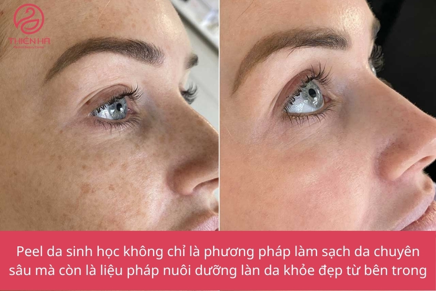  Lợi ích của peel da sinh học