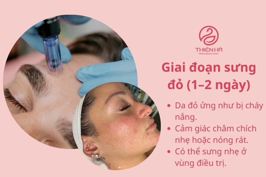 "Tình trạng sưng đỏ thường gặp sau khi lăn kim."