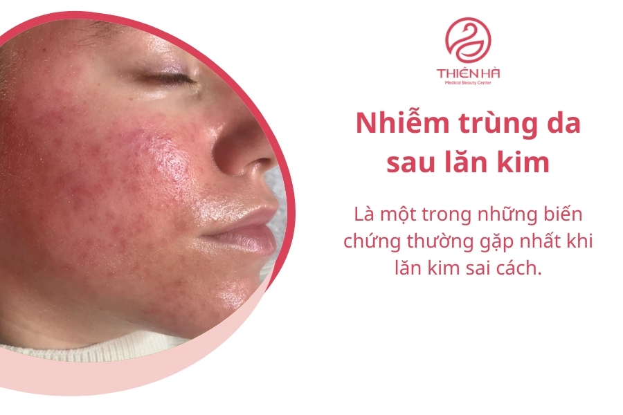 Da bị đỏ, sưng, đau và có thể xuất hiện mủ nếu dụng cụ lăn kim không được vô trùng kỹ lưỡng hoặc kỹ thuật thực hiện sai.