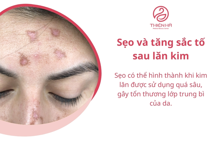 Sẹo lõm hoặc sẹo lồi có thể hình thành sau lăn kim nếu không được thực hiện đúng cách hoặc chăm sóc da sau điều trị không đúng quy trình.