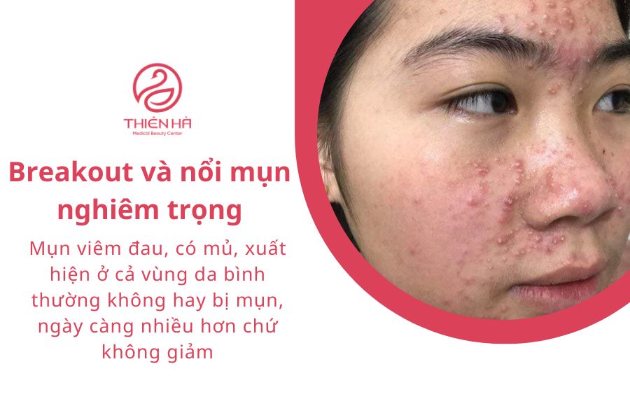Mụn bùng phát nghiêm trọng là một trong những tác hại của lăn kim khi lăn kim sai cách