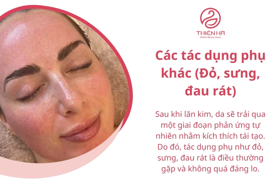 Các tác dụng phụ khác (Đỏ, sưng, đau rát)