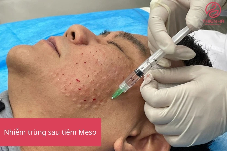 Hình ảnh vùng da bị đỏ, sưng tấy sau tiêm Meso biểu hiện điển hình của nhiễm trùng cần can thiệp y tế.