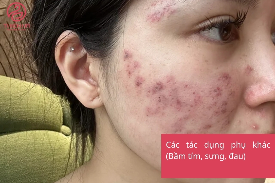 Hình ảnh vùng da bị bầm tím nhẹ sau khi tiêm Meso – phản ứng phổ biến nhưng tạm thời, thường tự biến mất sau vài ngày.