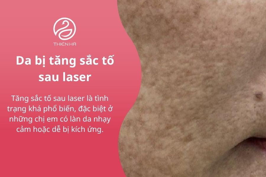 Tăng sắc tố da