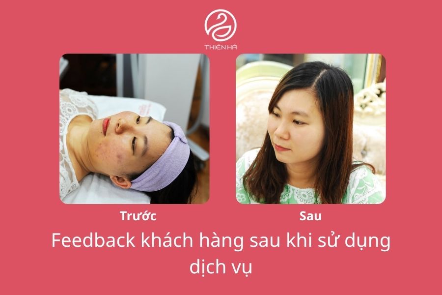 Vi kim tảo biển: Tác dụng, quy trình & lưu ý từ Bác sĩ Thiên Hà 7 Hình ảnh trước và sau khi thực hiện vi kim tảo biển tại Thẩm mỹ viện Thiên Hà