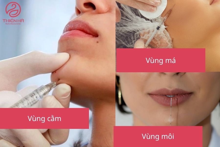 Các vùng tiêm filler phổ biến trên khuôn mặt