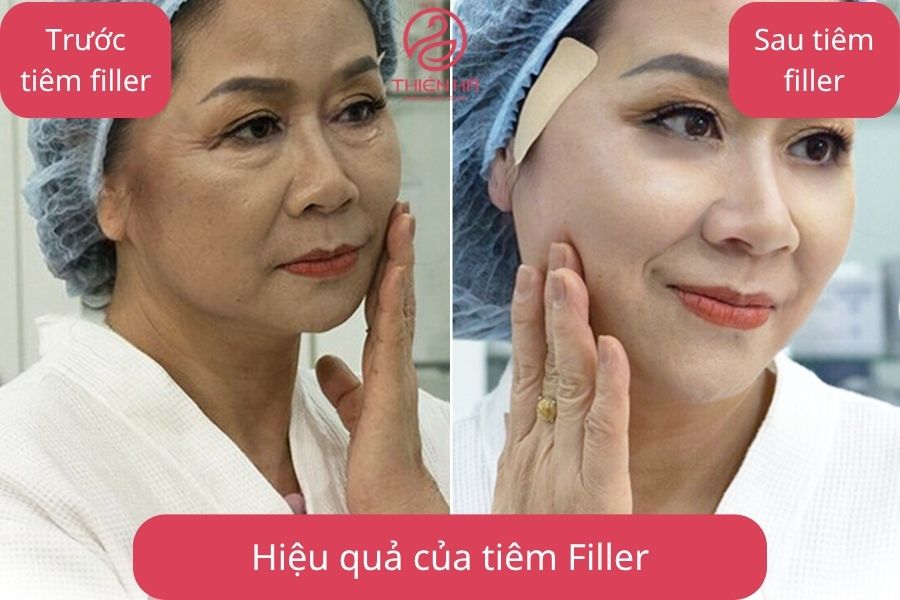 Kết quả trước và sau khi tiêm filler Teoxane tại Viện Thẩm Mỹ Thiên Hà